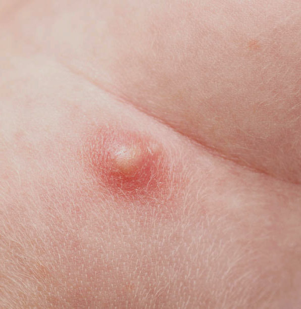 Abscess Meaning in Tamil |  Abscess Definition in Tamil